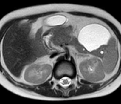 Walled off necrosis (WON) Pancreatic