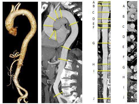 imaging of the aorta diameter over time to assess change in diameter Use the same