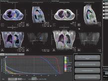ADAPT Auto-Contour MRIdian Linac provides real-time imaging that clearly defines the targeted tumor from the surrounding soft tissue and other critical organs.