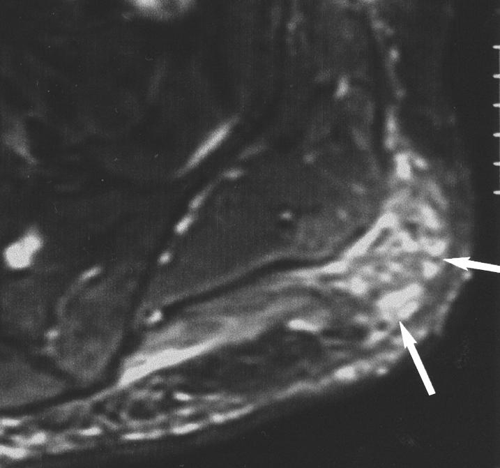 , Sagittal T2-weighted image (TR/TE, 2400/90) shows lesion has central high signal intensity and low-signal-intensity rim (arrow).