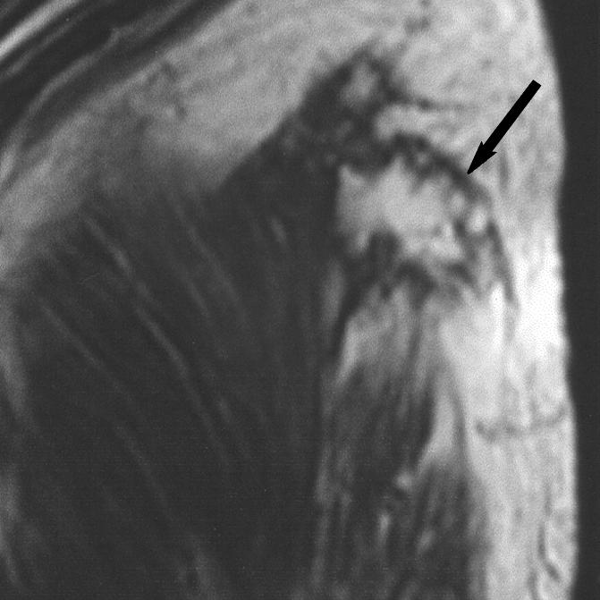 D, Sagittal fat-suppressed T1-weighted gadolinium-enhanced image (500/16) shows lesion is hypointense with irregular rim enhancement (arrows).