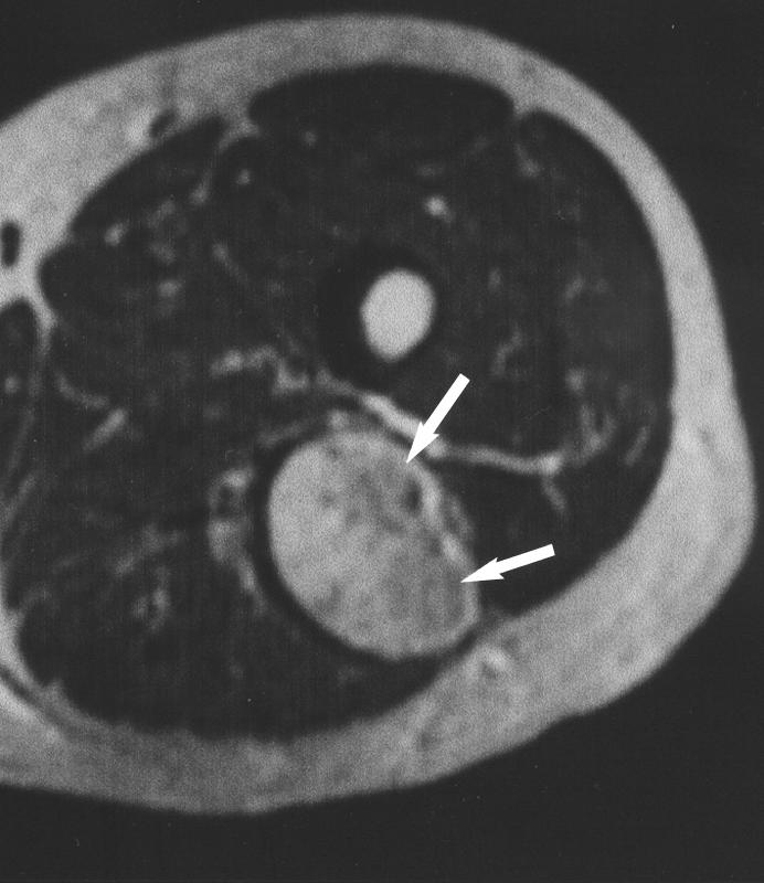 Imaging Features of Fat Necrosis Fig. 3. 50-year-old man with mass at posterior aspect of thigh. Fat necrosis was confirmed after core biopsy.