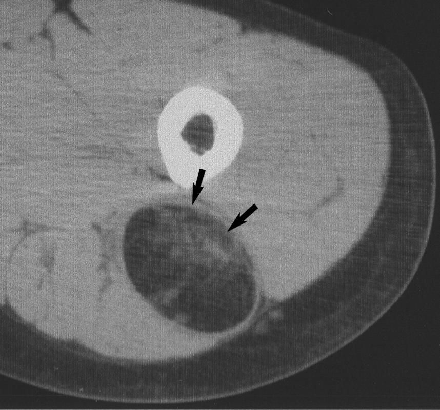 morphous cloudlike areas of stranding (arrows) can be seen at lateral aspect of lesion.