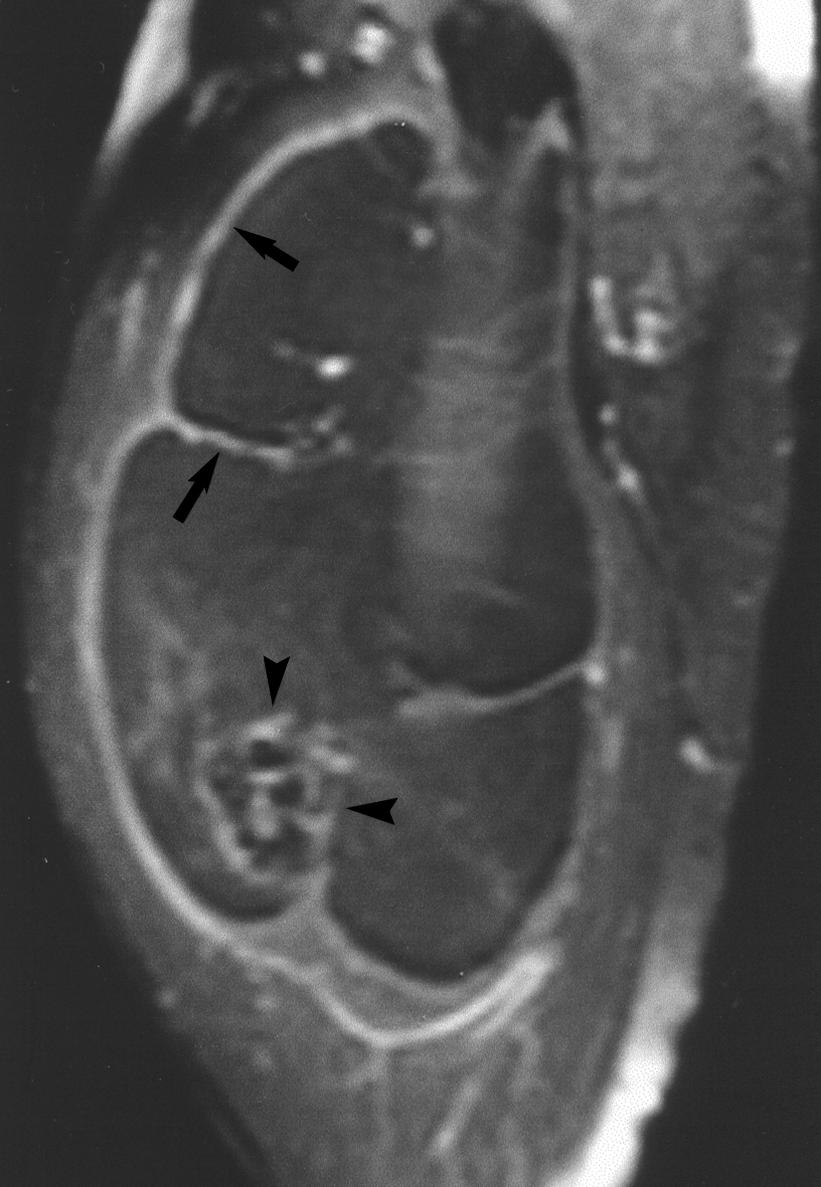 Lesion otherwise mirrors signal of subcutaneous fat on all sequences (not shown). Discussion Fat necrosis in the extremities is a known entity but is not well documented.