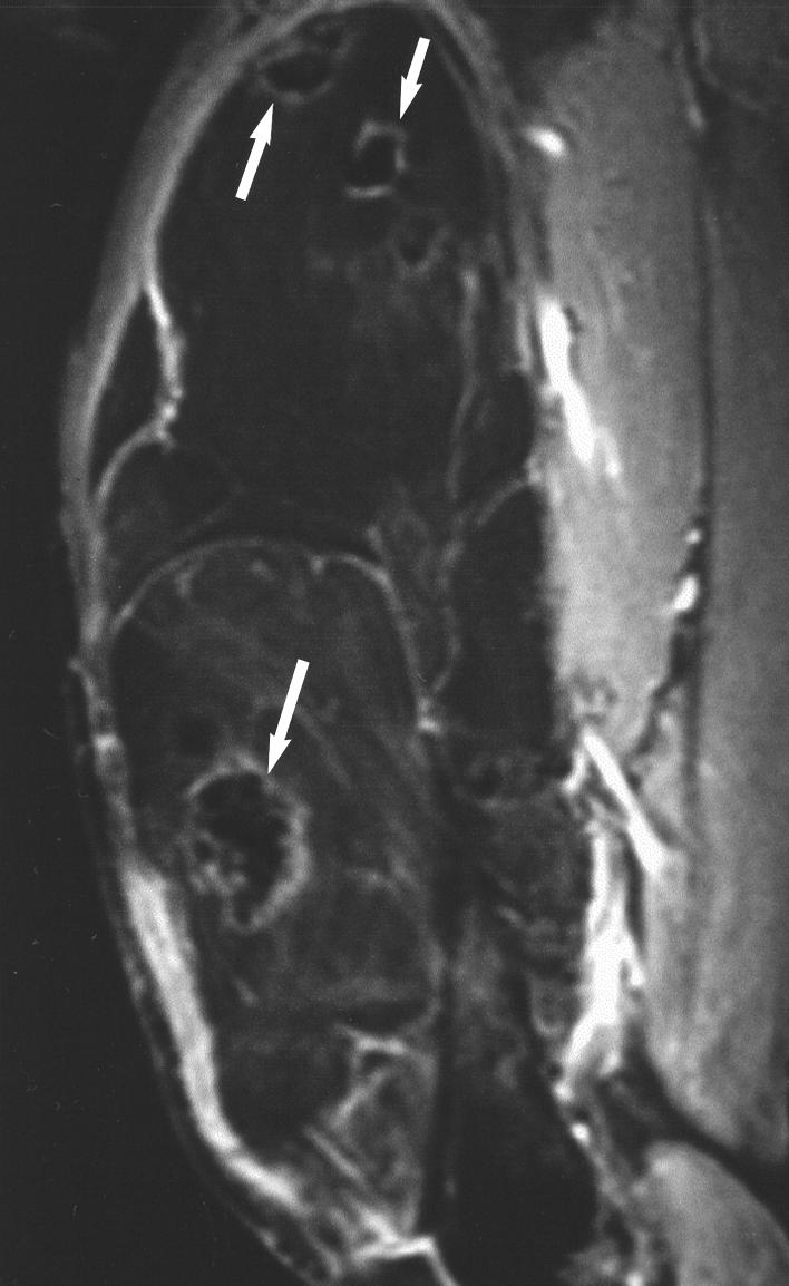 Chan et al. Fig. 5. 67-year-old man with enlarging mass in anterior right thigh. This lesion was resected and found to be atypical lipoma with multiple areas of fat necrosis.
