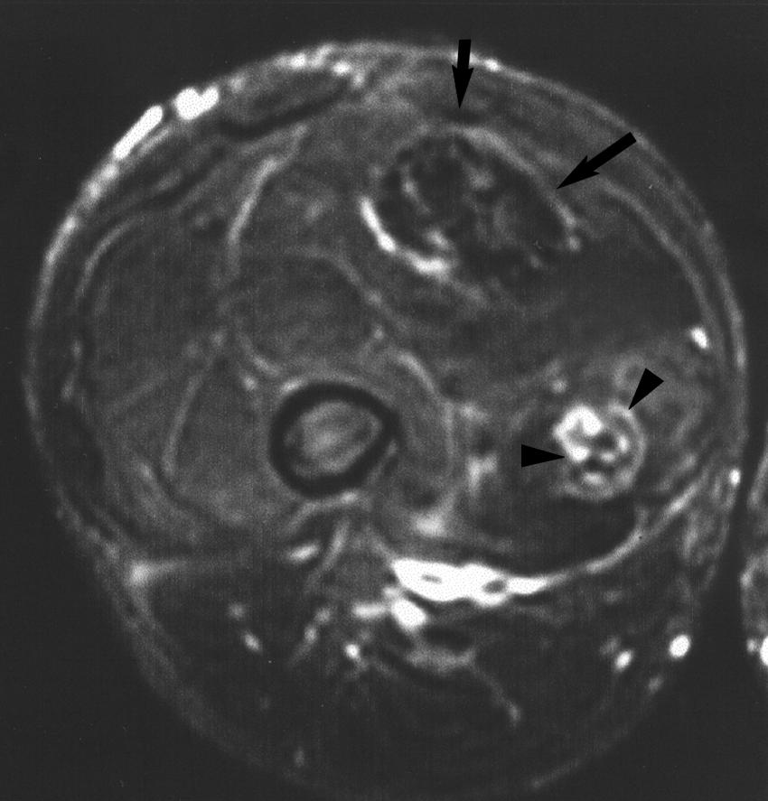 Two nodules with hypointense rims and hyperintense centers (arrows) are present.
