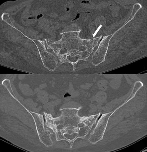 Fig. 3. (A) Axial computed tomography (CT) image of the pelvis 2 months after the right sacral insufficiency fracture showing a new fracture line (white arrow).