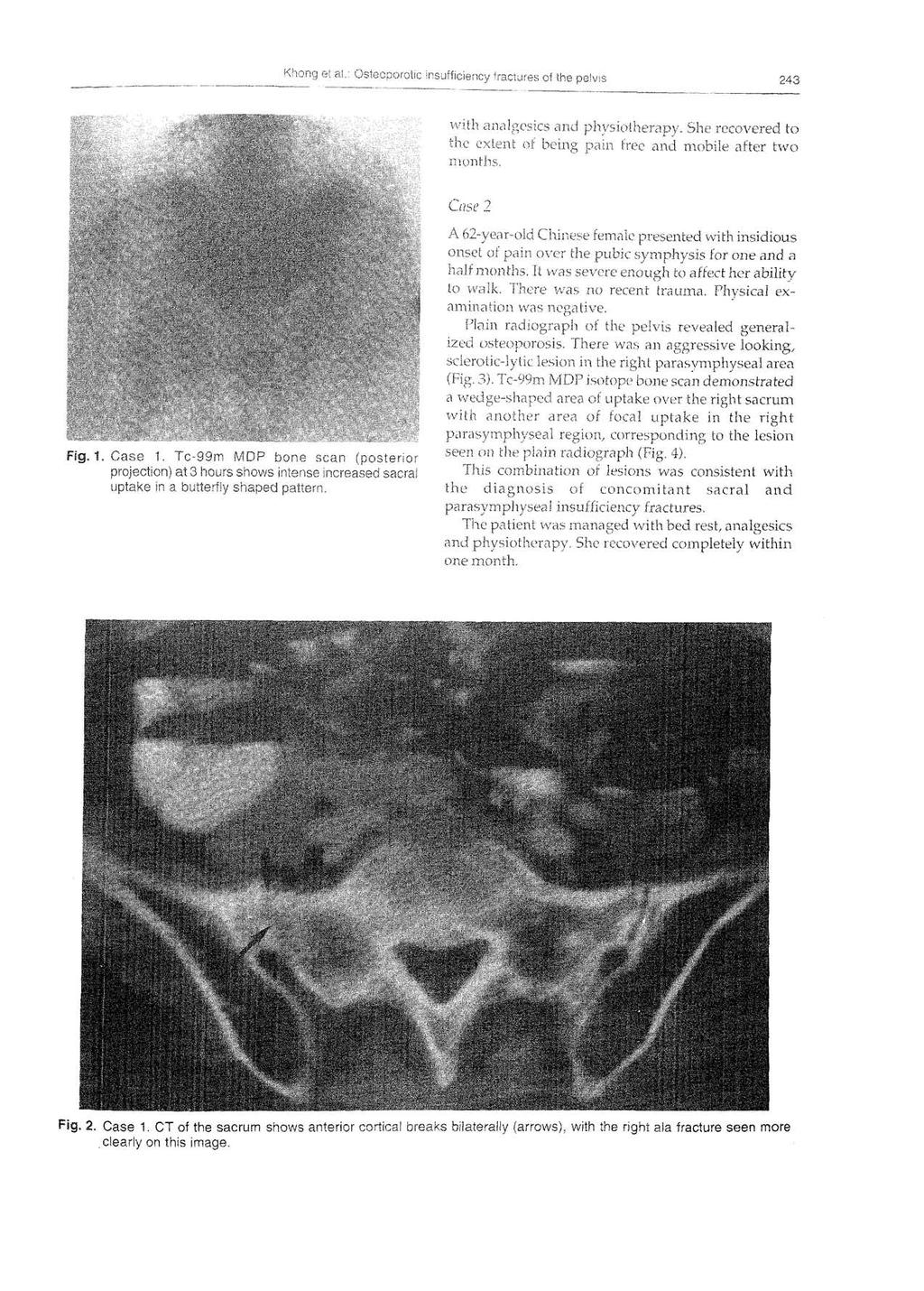 243 Fig. 1. Case 1. Tc-99m MDP bone scan (posterior projection) at 3 hours shows intense increased sacral uptake in a butterfly shaped pattern.