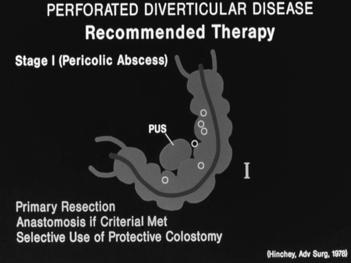 Treatment of Complicated Diverticulitis H&P - CT
