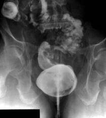 Primary Anastomosis and Colonic Lavage Leahy Clinic 33/62 pts with nonelective operations for diverticulitis had intraoperative colonic lavage for obstruction, abscess/phlegmon, perforation no