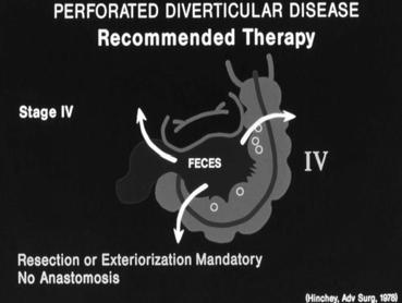Treatment of Acute Diverticulitis H&P - CT "Fat