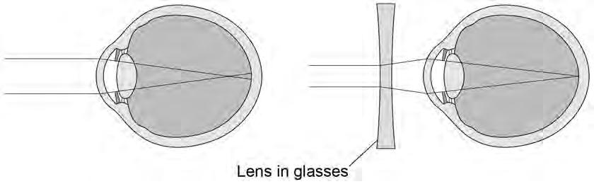 17 0 5. 2 Some people wear glasses to improve their vision. Figure 5 shows light entering the eye in a person with blurred vision.