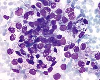 Papilarni karcinom smo pravilno ugotovili pri 14 od 15 (93,3 %) histopatološko potrjenih tumorjev (slika 4A, slika 4B).