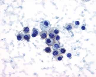 Pozitivna imunocitokemična reakcija na označevalec P504S (racemaza), ki je značilno pozitiven v teh karcinomih (spodaj) (x600).