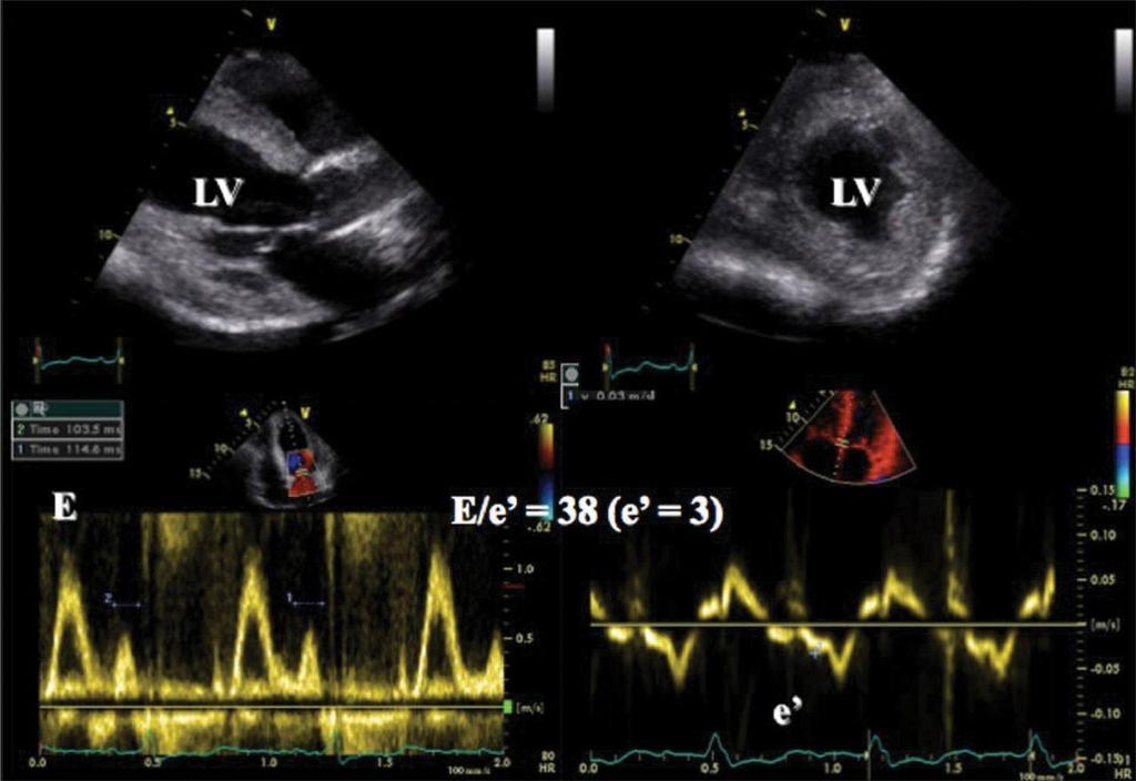 Echocardiographic examination showing preserved left ventricular (LV) systolic function in a patient