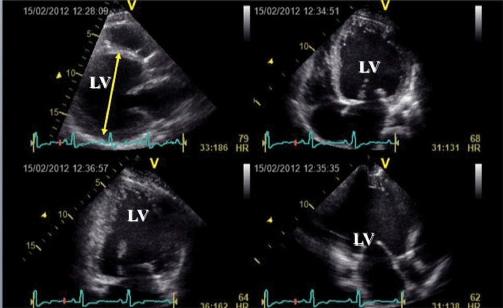 Echocardiographic examination showing dilated cardiomyopathy and depressed left ventricular (LV) systolic function