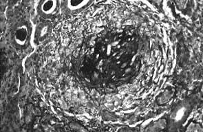 Vasculitis (Polyarteritis Nodosa, Microscopic Polyangiitis, Wegener s Granulomatosis, Henoch-Schönlein Purpura) 2.