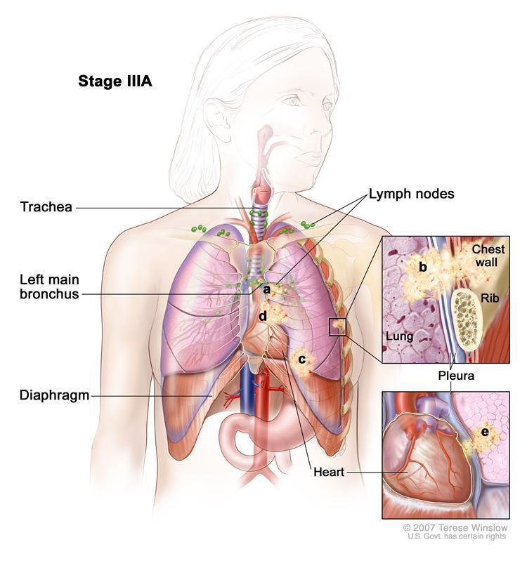 Stage IIIA The cancer has spread to ipsilateral mediastinal or subcarinal lymph nodes (N2).