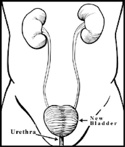 Neobladder This is the creation of a new bladder. This new bladder is a substitute bladder and will be placed in the same place as the old bladder.