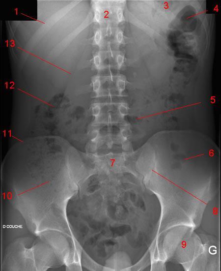 Normal X-ray: 1 13 12 11 10 16 3 4 2 14 15 5 6 7 8 9 1. 11 th rib. 2. T12 vertebra. 3. Gas in stomach. 4. Splenic flexure. 5. Transvers colon. 6. Gas in sigmoid. 7. Sacrum. 8. SI (sacroiliac) joint.