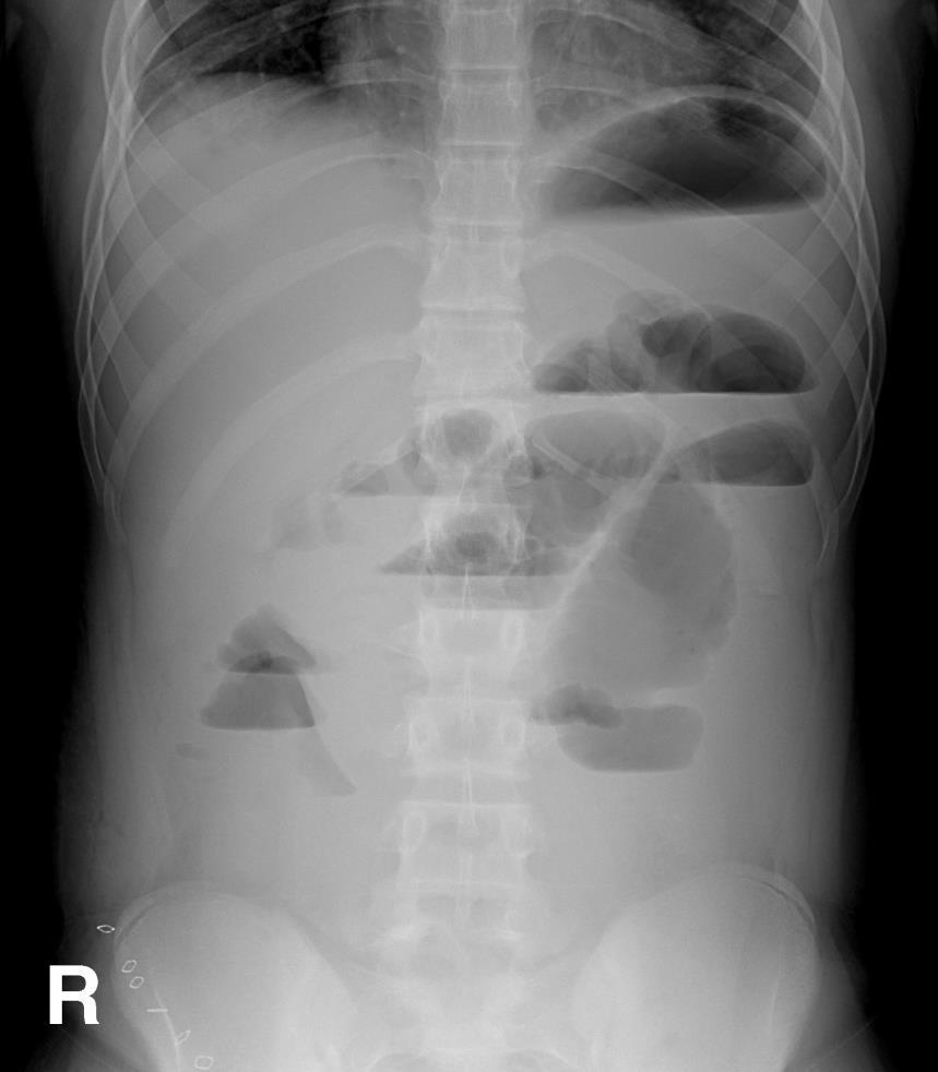 Abnormal X-ray: Bowel Obstruction* Is this