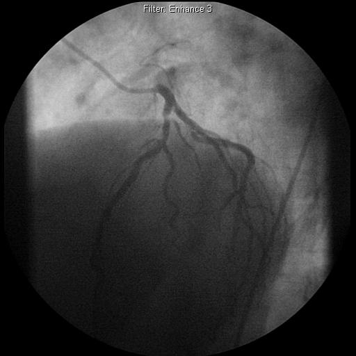 Our patient RG: Additional view of left coronary artery branches on coronary angiogram LCx Green