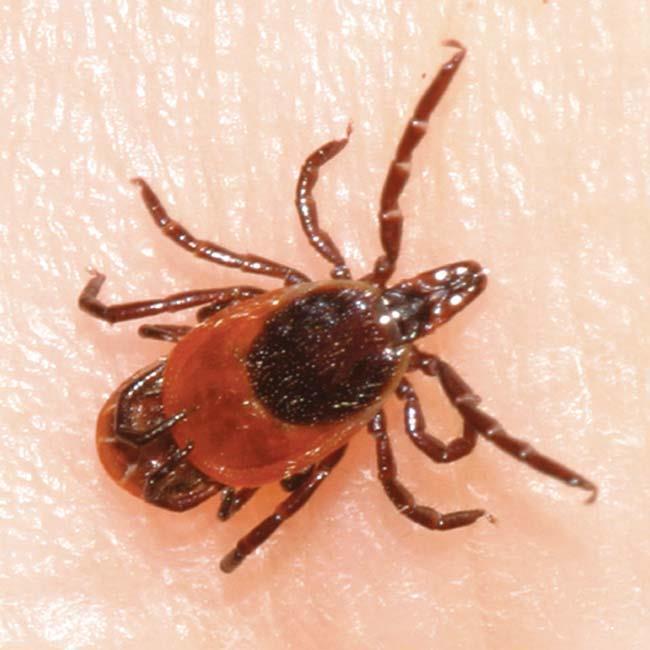 Babesiosis Babesiosis is acquired from the bite of a tick (Ixodes scapularis), more commonly called the blacklegged tick.