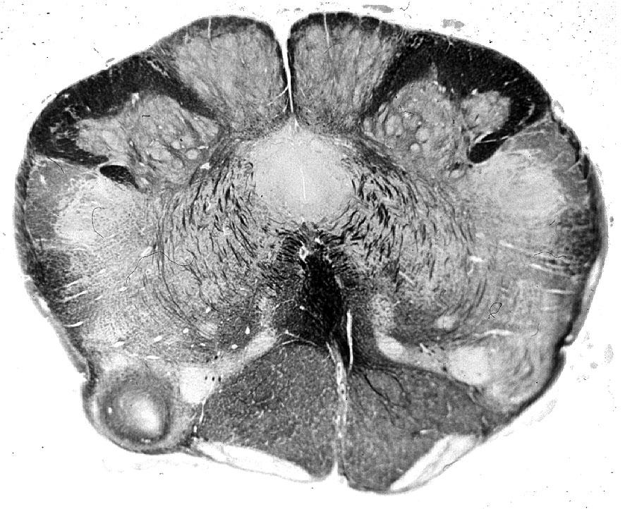 Ventral Posterior Lateral Post.