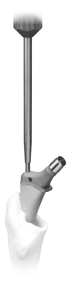 14 VerSys 6 Beaded FullCoat Plus Hip Prosthesis Place the Stem Impactor in the implant insertion slot located on the stem shoulder (Fig. 14).