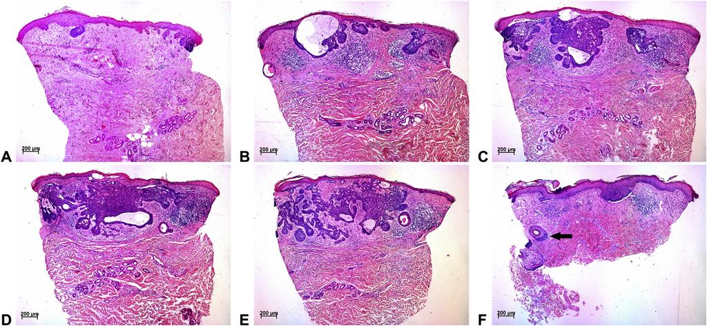 J AM ACAD DERMATOL Research Letters 353.e1 Supplemental Fig 1. Detection of various basal cell carcinoma subtypes and adnexal extension in hematoxylin-eosin-stained sections.