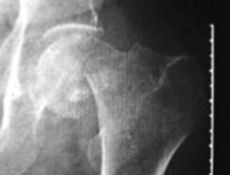 Our data shows that although of similar age, patients with a missed diagnosis of occult hip fracture appear physiologically less robust compared to the patients who are correctly suspected and