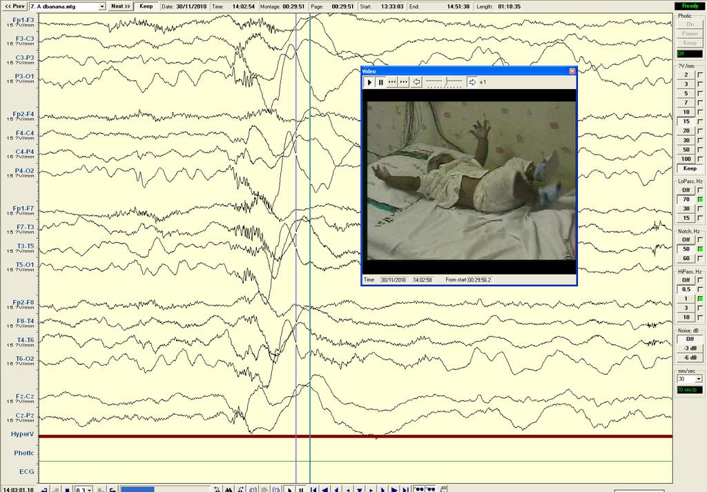 Ictal EEG: