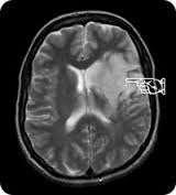 Major Plasticity Major plasticity follows brain damage, when undamaged