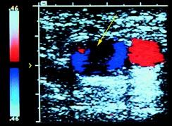 COVER STORY Table 2 Acquired conditions affecting functional hypercoagulability test results This color-flow Doppler ultrasound shows a vein with a noncompressible filling defect (arrow) consistent