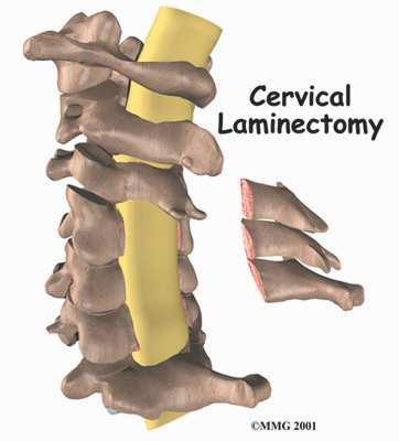 Introduction A laminectomy is a surgical procedure to relieve pressure on the spinal cord due to spinal stenosis.