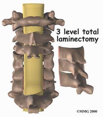 But these joints may have to be removed if they are enlarged with arthritis. During total laminectomy, the facet joints are removed.