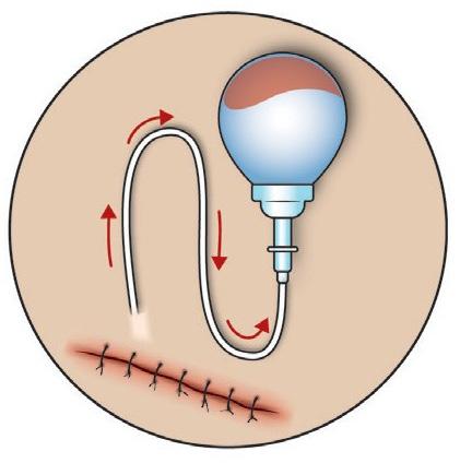 Rarely, a drain tube called a Hemovac or JP is put inside the neck near your incision to remove any extra fluid under your skin. Do not pull on it or try to empty the attached plastic bulbs.