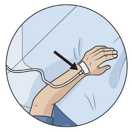 We use your IV to give you fluid and medication during and after your surgery. We usually take the IV out as soon as you can start eating and drinking well (usually right after surgery).