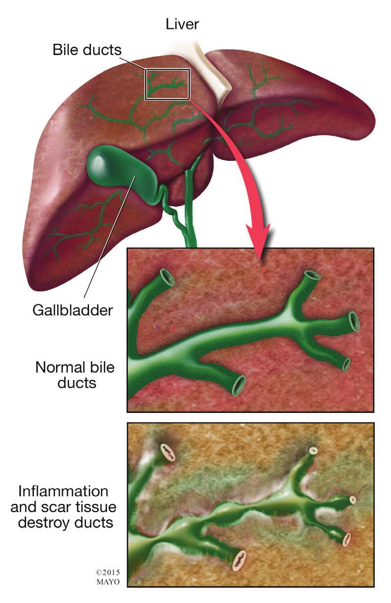 What is Primary Biliary Cirrhosis? Primary biliary cirrhosis (PBC) is a chronic liver disease resulting from progressive destruction of the bile ducts in the liver called the intrahepatic bile ducts.