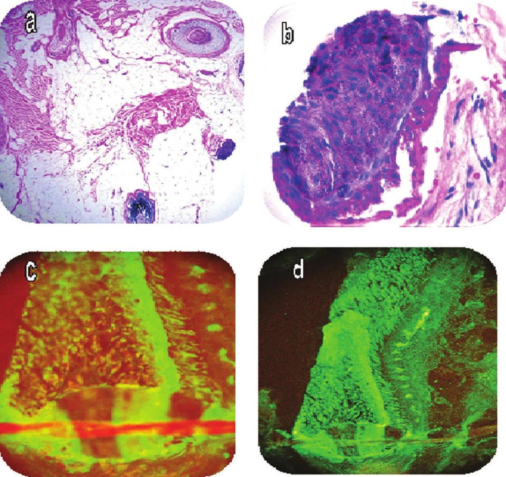 Figure 3. a H&E staining shows a deep dermal and subcutaneous adipose tissue area with some hair remnants, and some alterations of the extracellular matrix. b.