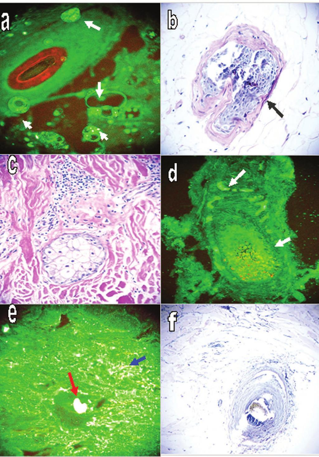 Positive DIF staining in a hair follicle with FITC conjugated anti-human IgD at higher (400x) and lower (200X) magnifications, respectively (green staining). Figure 2.