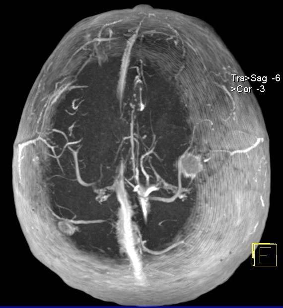 Australian Radiology, 44: 460-63, 2000. 3. Park MS et al: Multifocal meningioangiomatosis: a report of two cases. A]NR, 20: 677-80, 1999. 4. Alvernia JE et al: Preoperative neuroimaging findings as a predictor of the surgical plane of cleavage: prospective study of 100 consecutive cases of intracranial meningioma.