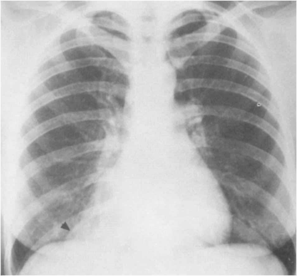 (C= cephalad) In October 1975, a preemployment chest radiograph again revealed the mass, and the patient was evaluated at another hospital.