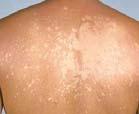 Malassezia furfur Normal skin flora in more than 90% of adults Tinea versicolor; cradle cap; dandruff Catheter-related sepsis (neonates, TPN) with secondary