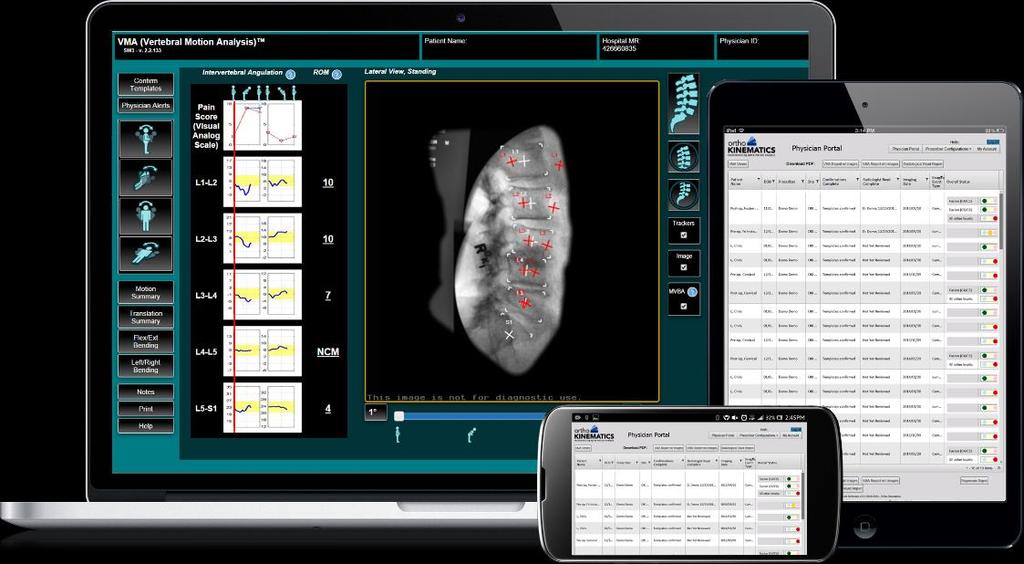 Personalized Red / Yellow / Green Light Alert System The VMA online system allows surgeons to set personalized thresholds for the detection of radiographic instability.