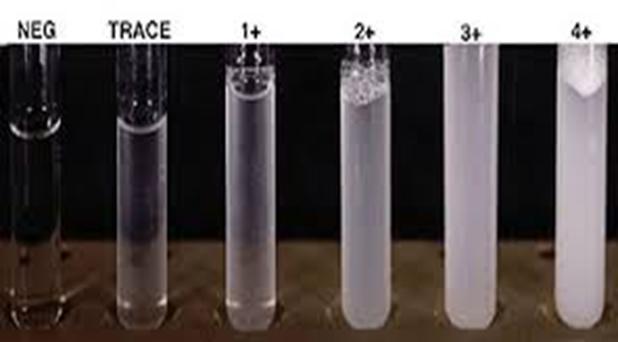 SULFOSALICYLIC ACID (SSA) TEST 0 = no turbidity (0 mg/dl) trace = slight turbidity (1 to 10 mg/dl) 1+ = turbidity through which print can be read (15 to 30 mg/dl) 2+ = white cloud without precipitate