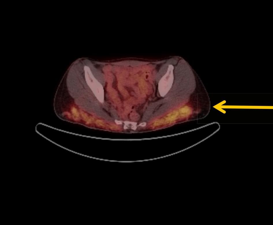 PET silicone granulomas in the gluteal region