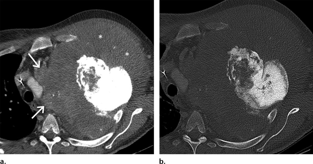 RG Volume 36 Number 5 Carter et al 1295 Figure 6. Advanced chest wall osteosarcoma in a 47-year-old man.