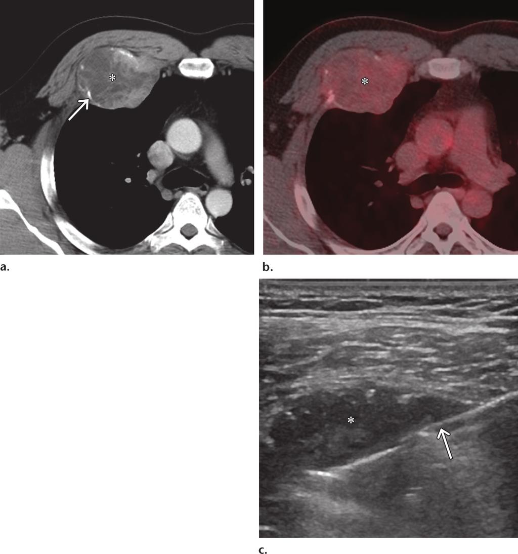 1296 September-October 2016 radiographics.rsna.org Figure 7. Ewing sarcoma of the right chest wall in a 37-year-old man.