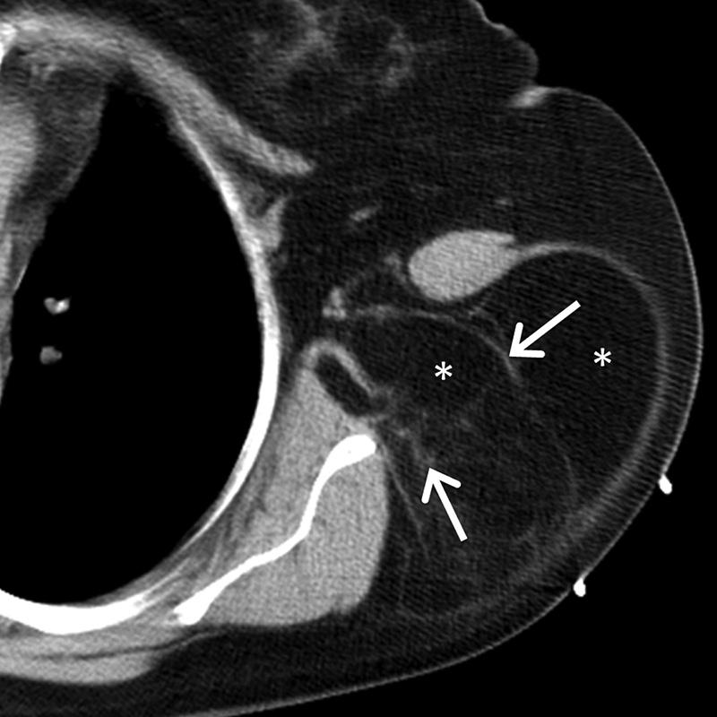 RG Volume 36 Number 5 Carter et al 1297 Figure 8. Liposarcoma of the left chest wall in a 51-year-old man who presented with left shoulder pain.